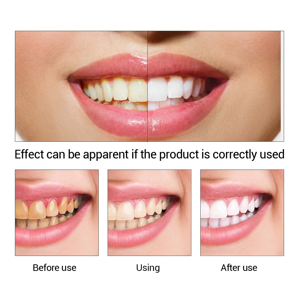 FTEENPLY Teeth Whitening Essen - огляд і ціна Teeth Whitening/Bleaching